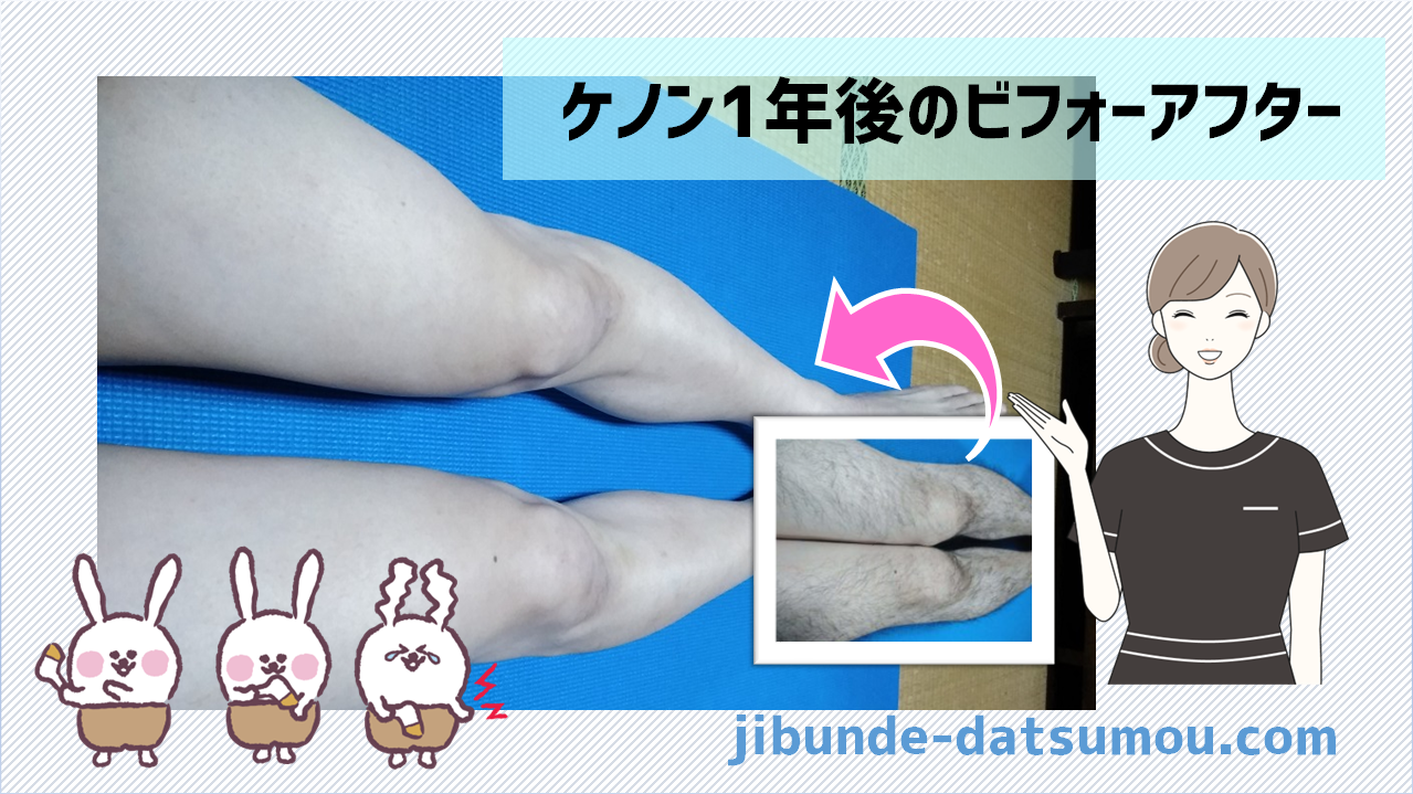 ケノン1年後ビフォーアフター脱毛できた部位とできない部位（半年放置 